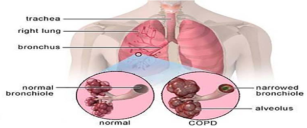 Introduction Chronic Obstructive Pulmonary Disorder Copd