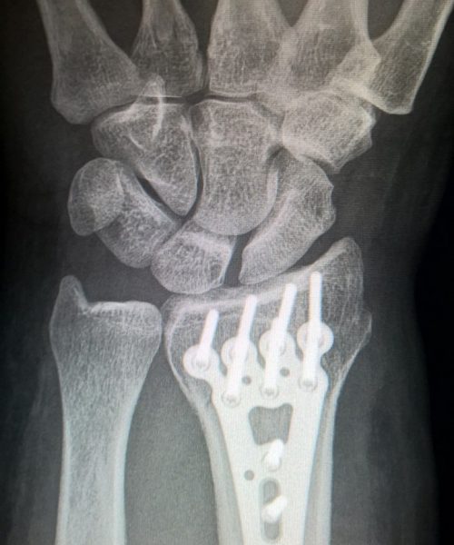 broken arm, plate fixation, titanium plate-2117980.jpg